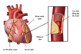 Xơ vữa động mạch